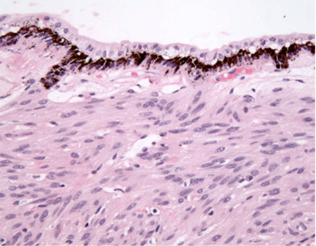 Eye pathology figure - Hematoxylin-Eosin Stain, 200x