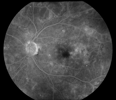 Fluorescein Angiogram, Diabetic Retinopathy 2