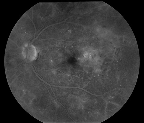 Fluorescein Angiogram, Diabetic Retinopathy 3