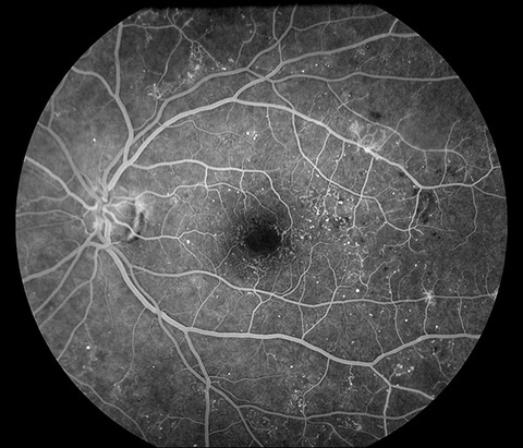 Fluorescein Angiogram, Diabetic Retinopathy 1