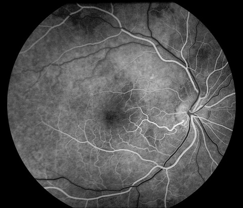 Normal Fluorescein Angiogram. Arterial phase illustrating sodium fluorescein dye in the retinal arteries before filling the retinal veins. 