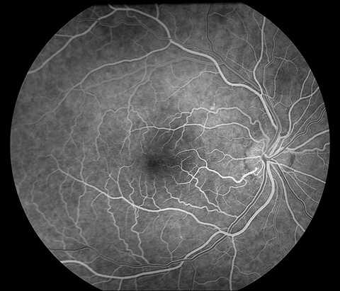 Normal Fluorescein Angiogram. Early venous phase illustrating sodium fluorescein dye beginning to fill the retinal veins.