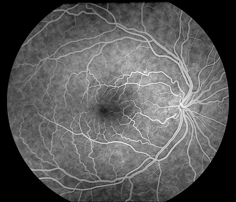 Normal Fluorescein Angiogram. Complete fill of retinal arteries and veins with sodium fluorescein dye.