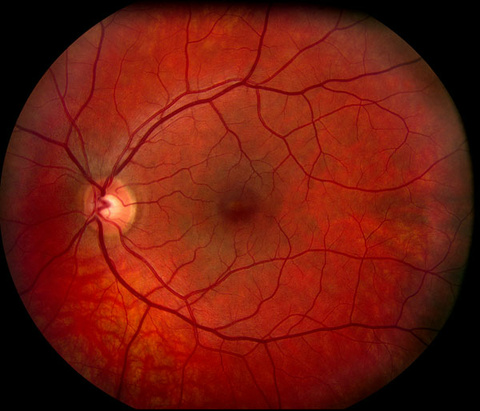 Normal Retina