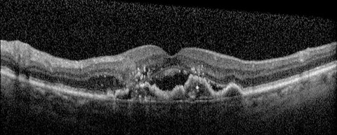 Figure 2. OCT, Age-related Macular Degeneration