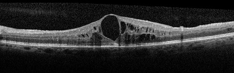 Figure 3. OCT, Cystoid Macular Edema