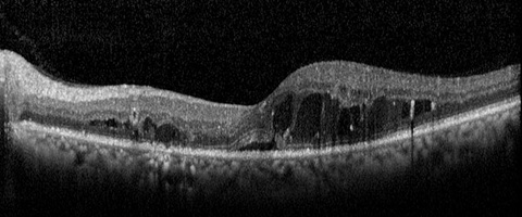 Figure 4. OCT, Diabetic Macular Edema