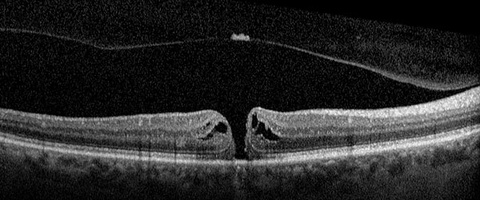 Figure 5. OCT, Macular Hole