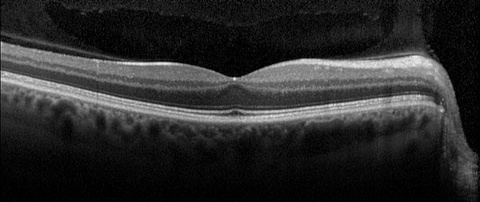 Figure 1. Normal OCT