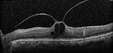 Figure 6. Vitreomacular Traction