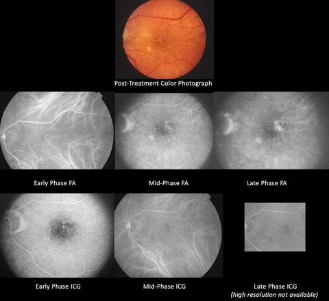 Indocyanine Green Angiography posttreatment