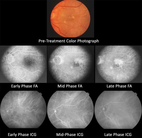 Indocyanine Green Angiography pretreatment