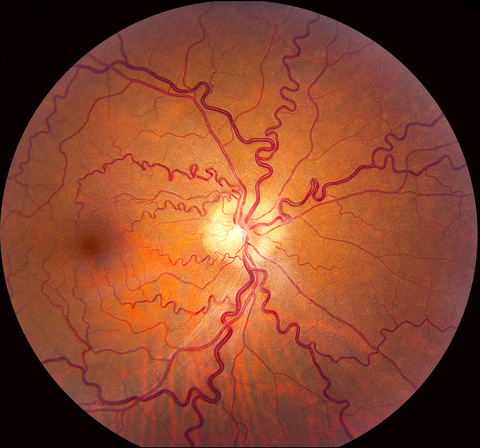 Probable Neurosarcoidosis