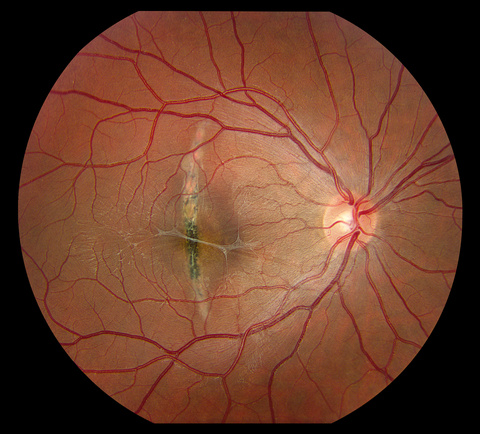 Choroidal Scar