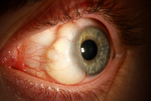 Conjunctival Cyst