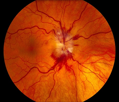 Compressive Optic Neuropathy