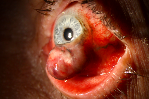 Conjunctival Lesion