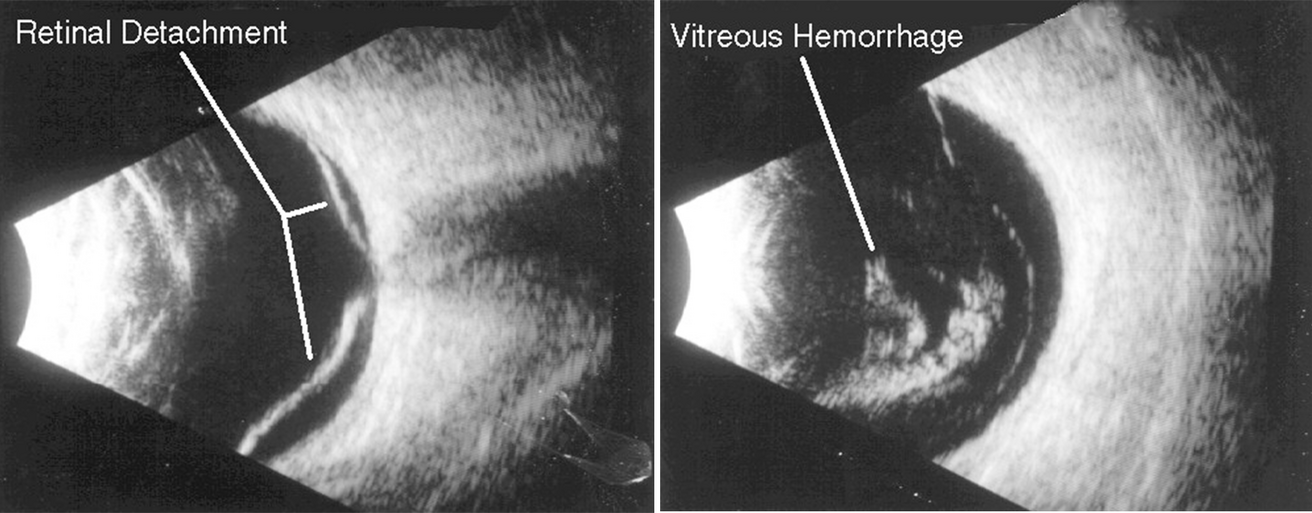 Retinal Detachment and Vitreous Hemorrhage