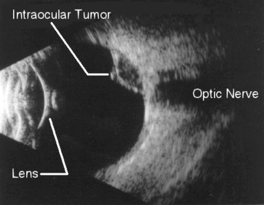 intraocular tumo